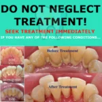 Ultrasonic Portable Tooth Cleaner